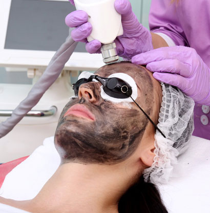 Carbon Peel Melbourne Carbon Peel Melbourne