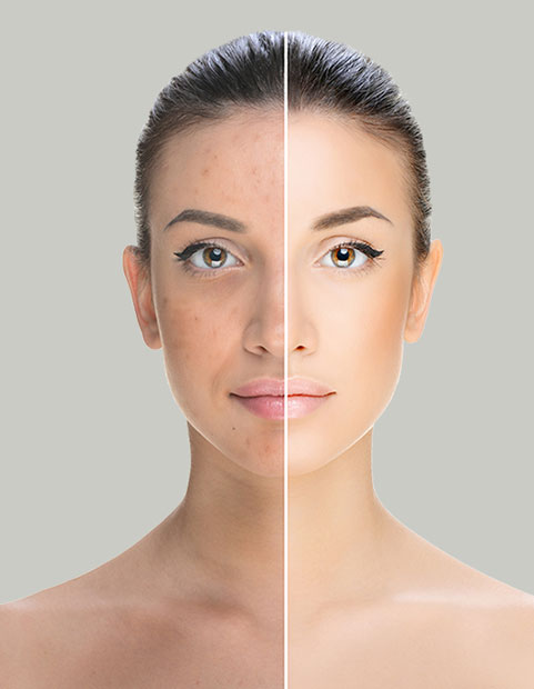 Laser Pigment Removal Melbourne Laser Pigment Removal Melbourne