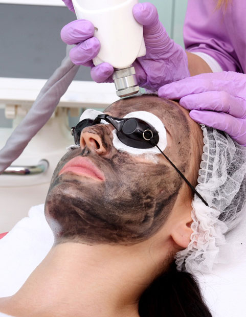 Carbon Laser Peel Melbourne Carbon Laser Peel Melbourne