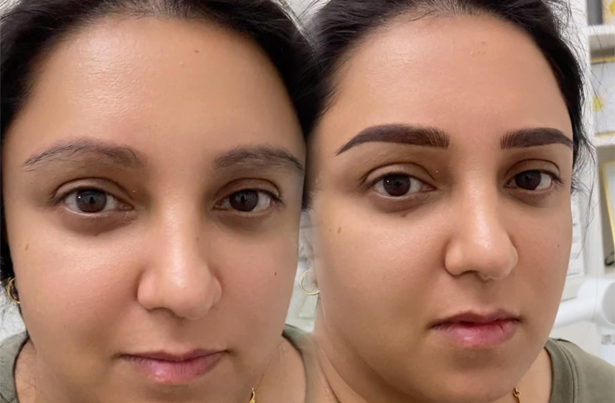 Correcting Eyebrow Tattoo Correcting Eyebrow Tattoo