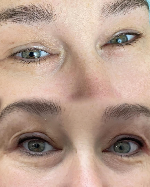 Before and After Eyeliner Tattoo Before and After Eyeliner Tattoo