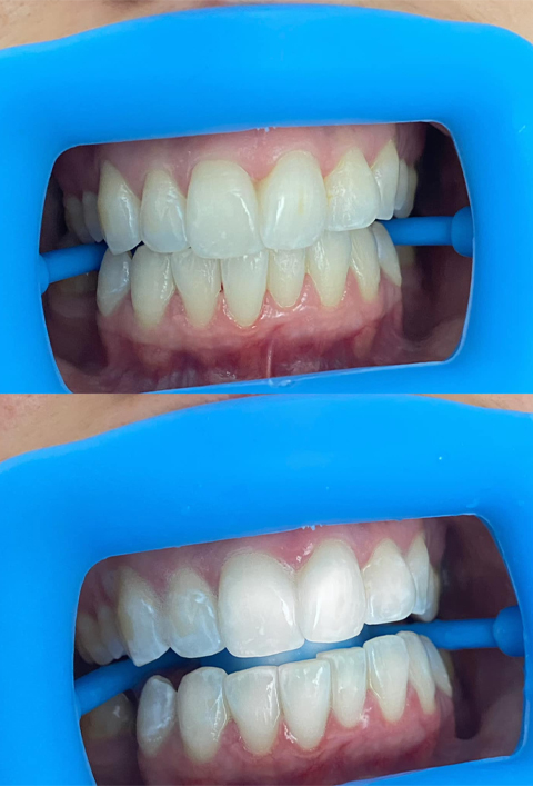 Laser Teeth Whitening in Melbourne Laser Teeth Whitening in Melbourne